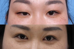 Upper Eyelid Surgery Los Angeles Ca
