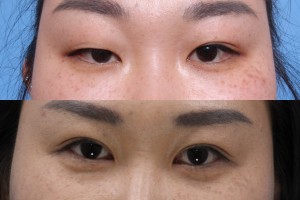 Lower Eyelid Surgery Los Angeles Ca Blepharoplasty Remove Eye Bags