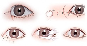 Upper Eyelid Surgery Los Angeles Ca
