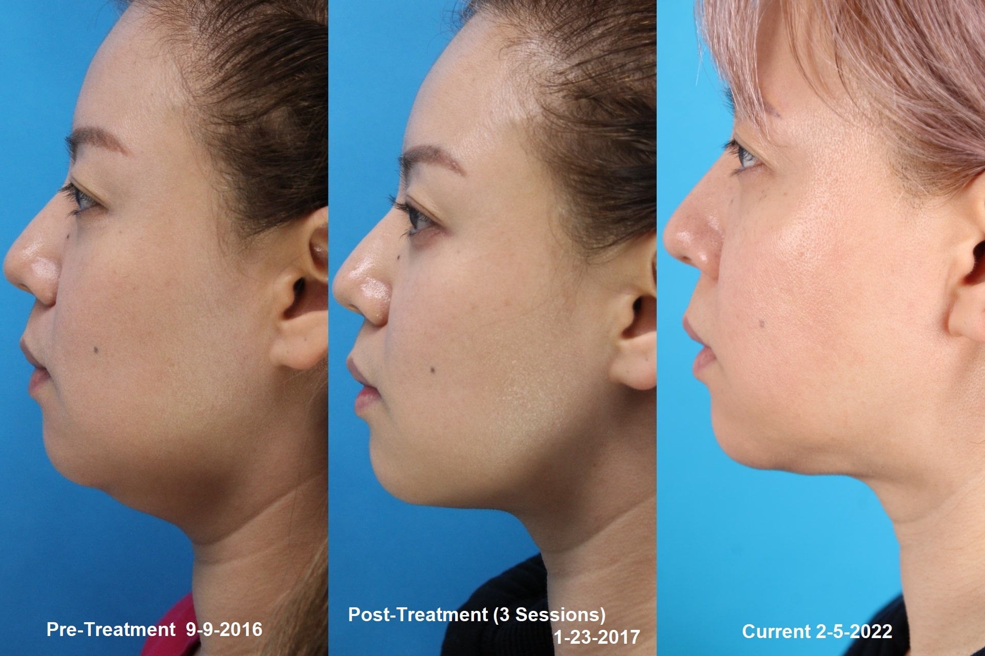 Kybella Vip Plastic Surgery