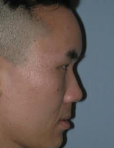 Forehead Augmentation
