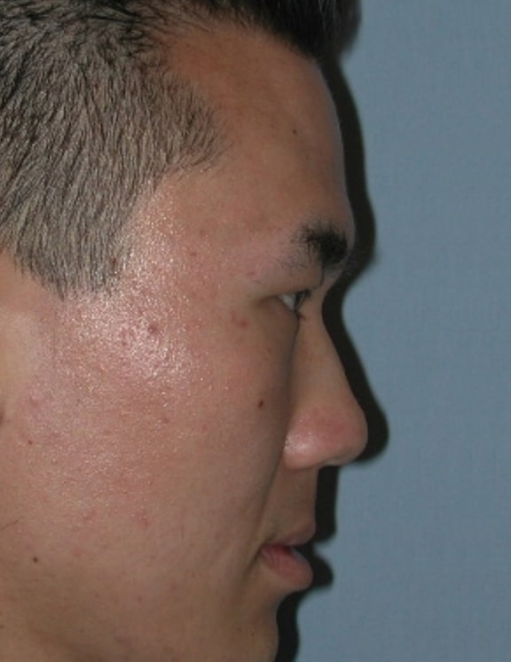 Forehead Augmentation