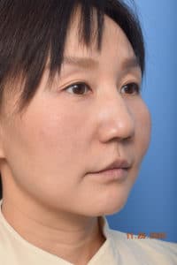 Kybella