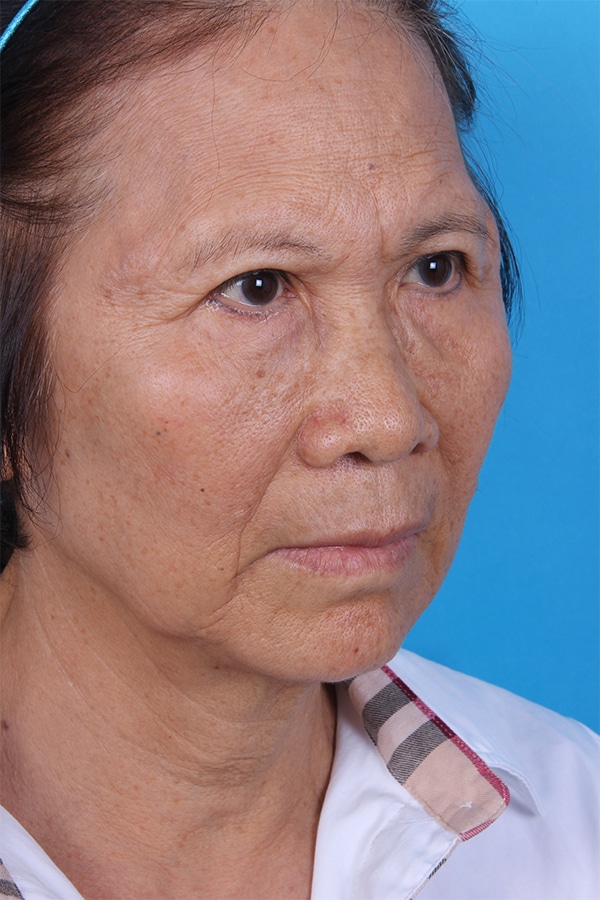 Before Image: Facelift - right-front-oblique