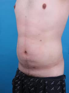 Liposuction