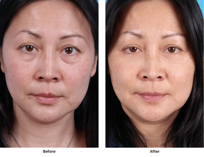 Under Eye Bags Surgery, eye bag removal | lower blepharoplasty