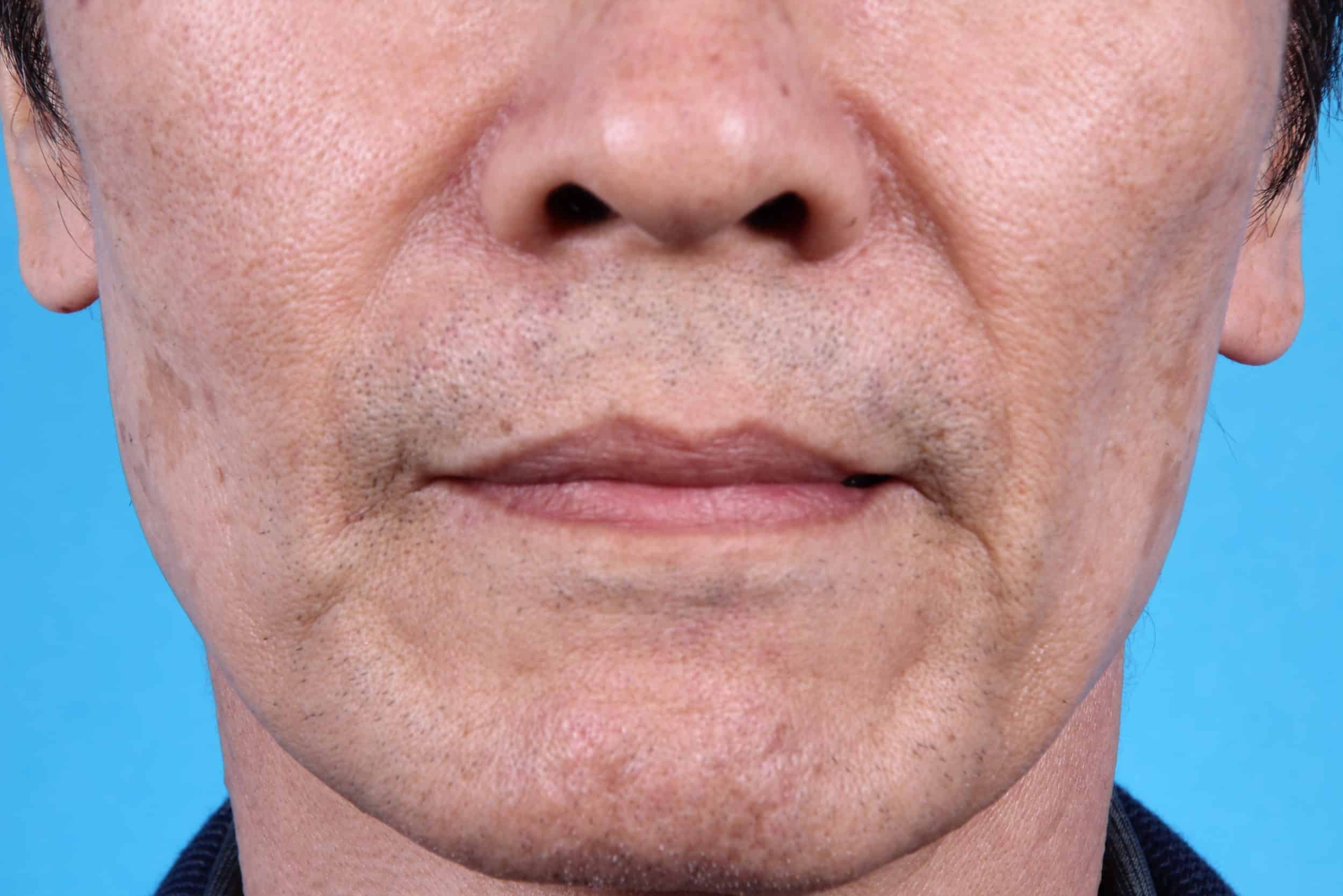 Radiesse Archives VIP Plastic Surgery