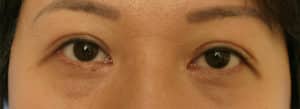 Epicanthoplasty
