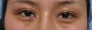 Epicanthoplasty