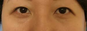 Epicanthoplasty
