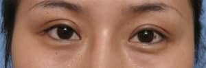 Epicanthoplasty