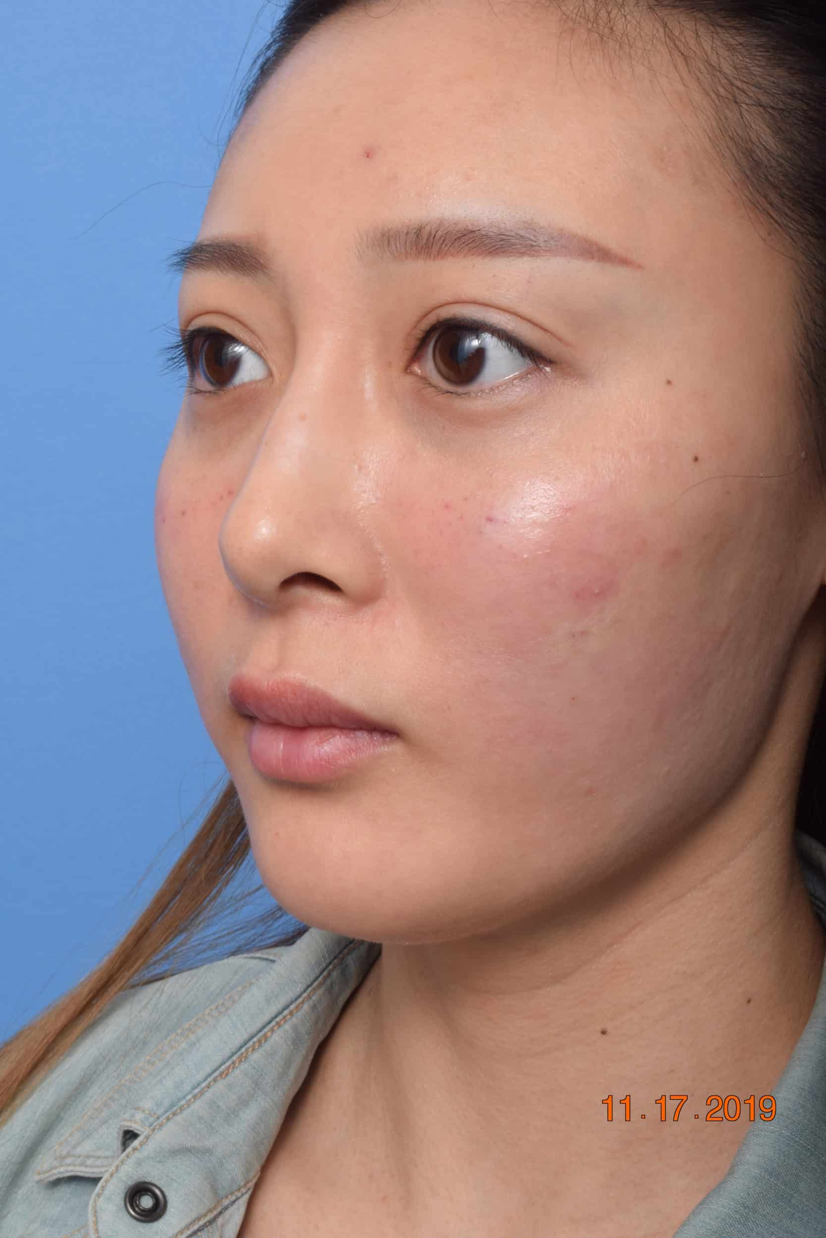 Belotero VIP Plastic Surgery