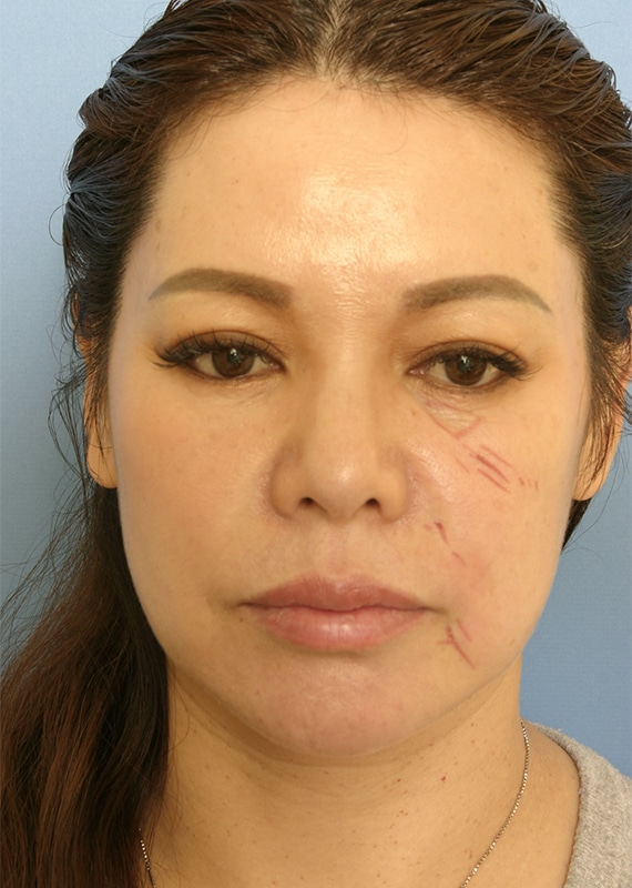 After Image: Upper Blepharoplasty - front