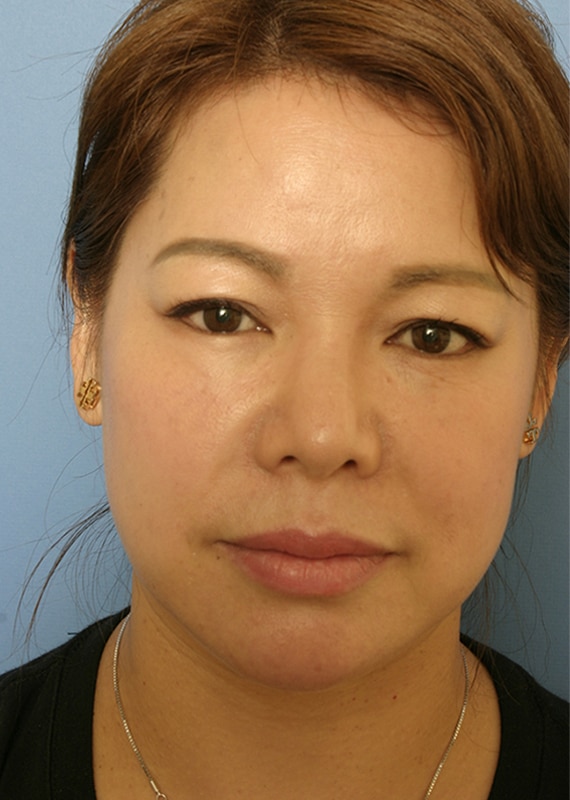 Before Image: Upper Blepharoplasty - front