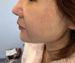After Image: Liposuction