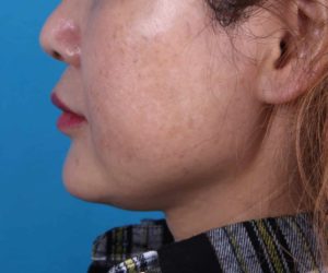 Before Image: Liposuction