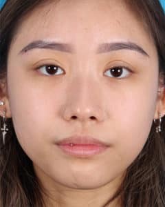 Ptosis Repair