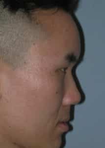 Forehead Augmentation