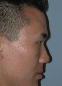 Forehead Augmentation