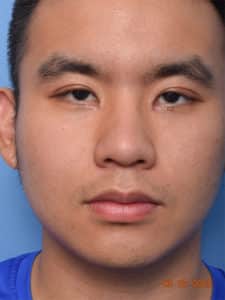Epicanthoplasty