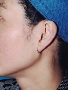 Ear Cosmetic Surgery