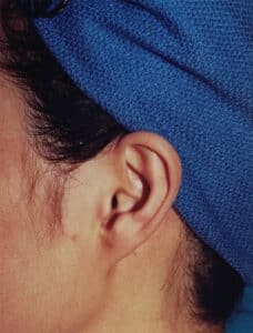 Ear Cosmetic Surgery