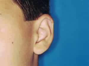 Ear Cosmetic Surgery