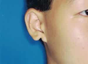 Ear Cosmetic Surgery