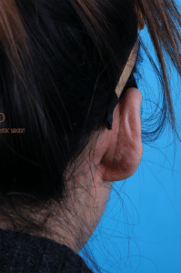 Ear Cosmetic Surgery