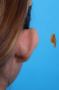 Ear Cosmetic Surgery