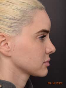 Juvederm Voluma