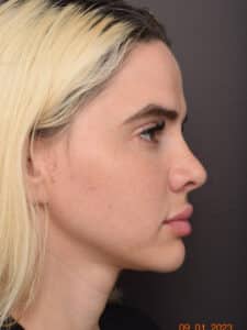 Juvederm Voluma