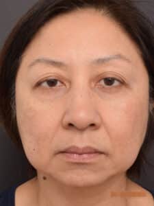 Upper Blepharoplasty