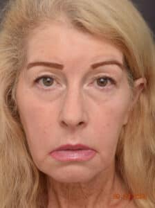 Upper Blepharoplasty