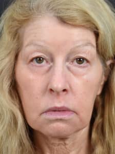 Upper Blepharoplasty