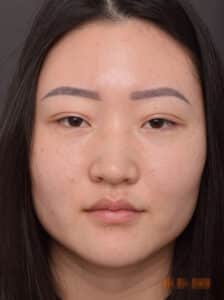Upper Blepharoplasty