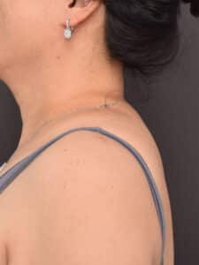 Liposuction-Buffalo Hump