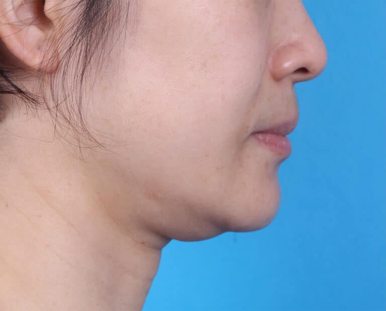 Before Image: Jowl Liposuction - right-side