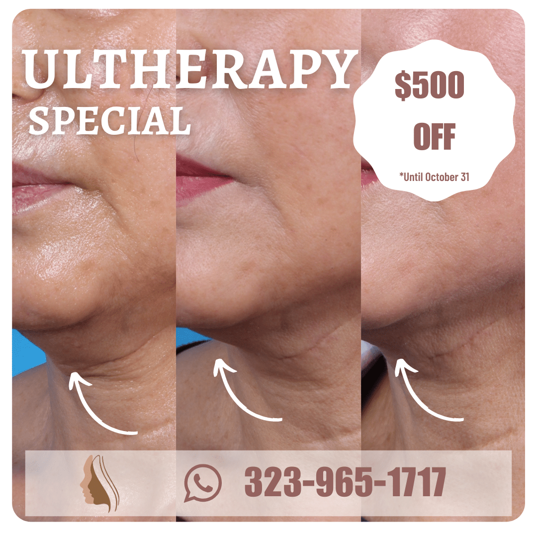 Ultherapy Promo
