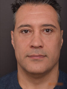 After Image: Lower Blepharoplasty and Upper Blepharoplasty