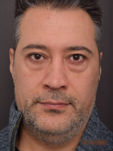 Before Image: Lower Blepharoplasty and Upper Blepharoplasty