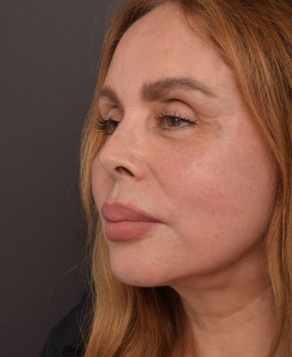 After Image: Facelift - left-front-oblique