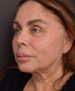 Before Image: Facelift
