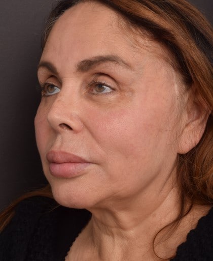 Before Image: Facelift - left-front-oblique