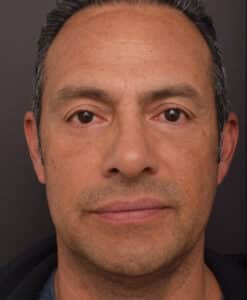 After Image: Lower Blepharoplasty