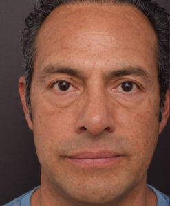 Before Image: Lower Blepharoplasty