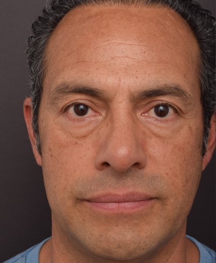 Before Image: Lower Blepharoplasty - front