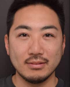 After Image: Upper Blepharoplasty and Lower Blepharoplasty