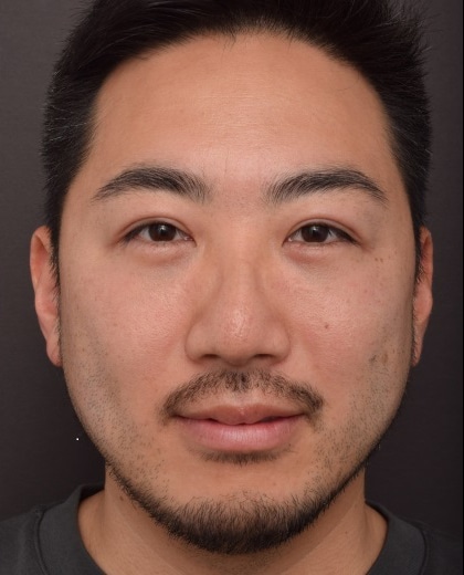 After Image: Upper Blepharoplasty and Lower Blepharoplasty - front