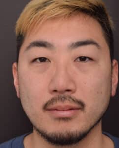 Before Image: Upper Blepharoplasty and Lower Blepharoplasty